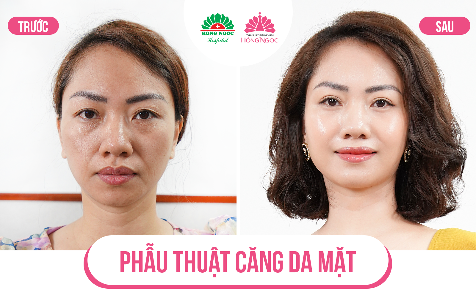 phẫu thuật căng da mặt